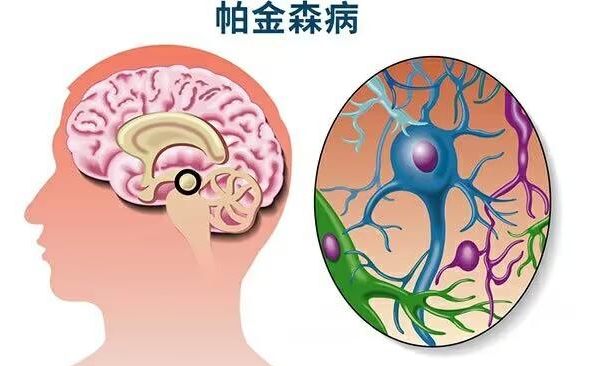世界帕金森病日是幾月幾日,世界帕金森病日是哪一天